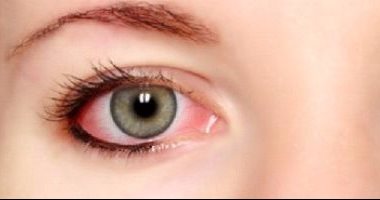 تعرّف على أعراض وأسباب التهاب العين عند الأطفال