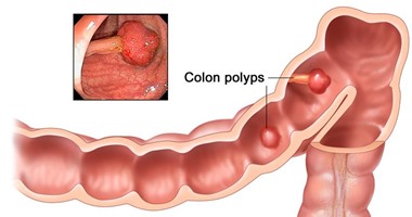 سرطان القولون.. أعراضه وأسبابه وعلاجه