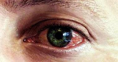 6 أسباب تؤدي إلى نزيف العين
