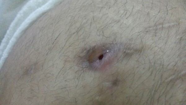 بالصور.. 7 عمليات تنهك جسد “وائل” وتبقي بطنه مفتوحاً منذ 5 أشهر