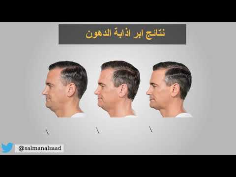 بالفيديو.. سلمان السعد: 3 طرق للتخلص من الدهون