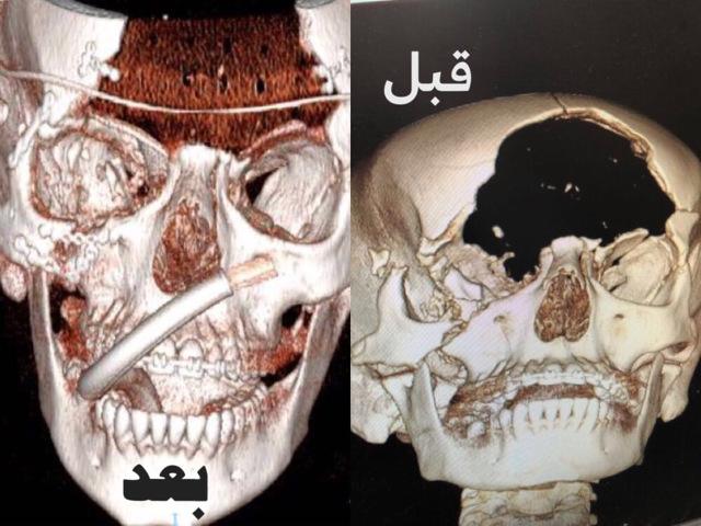 ترميم جبهة فتاة بسعود الطبية 