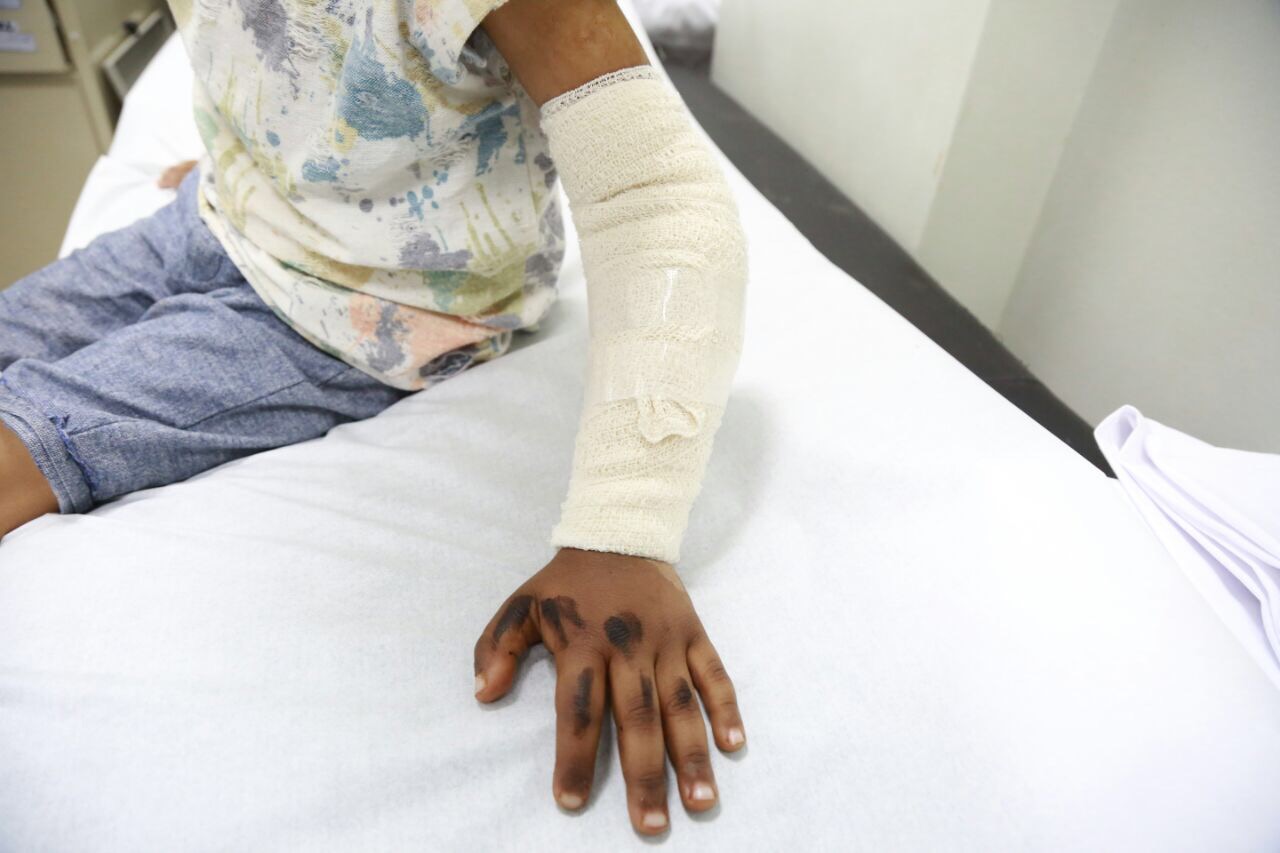 إنقاذ يد طفل من البتر بسعود الطبية