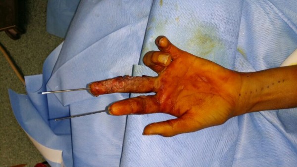 بالصور.. مستشفى بلجرشي ينقذ يد مواطن من البتر