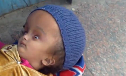 بالفيديو.. “بسنت” .. طفلة مصرية تعيش بدون مخ