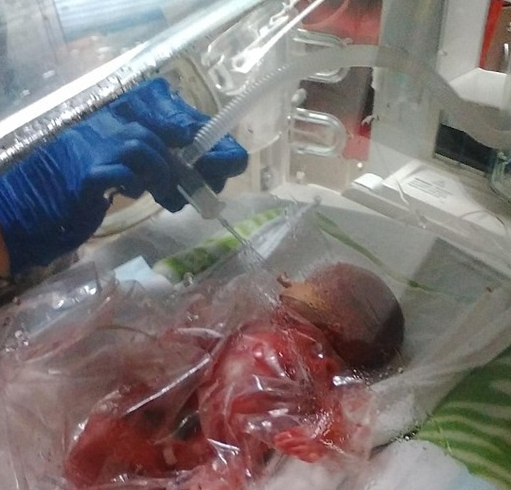 بالصور.. أطباء يضعون طفلًا ولد قبل موعده في كيس بلاستيكي !