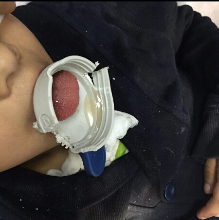 إنقاذ طفل من احتباس حلقة بلاستيكية داخل حلقه بـ #الدمام