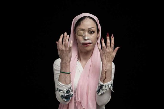 اسيد الباسيج يشوه 380 امرأة في إيران (2)
