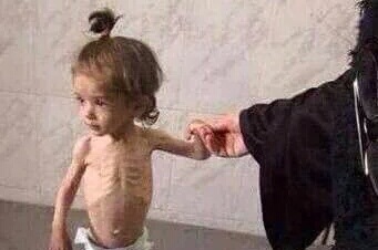اطفا سوريا يموتون جوعا (2)