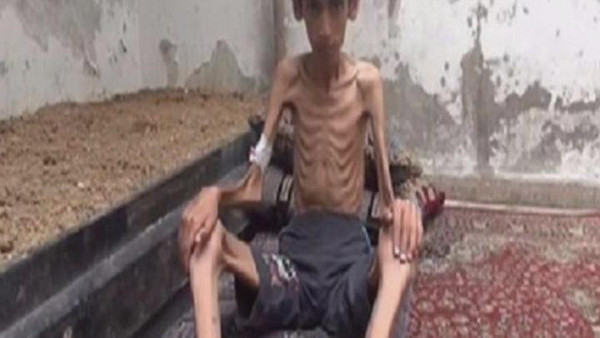 اطفا سوريا يموتون جوعا (3)