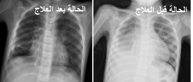 لأول مرة بالشرق الأوسط.. علاج طفل من التهاب رئوي نادر