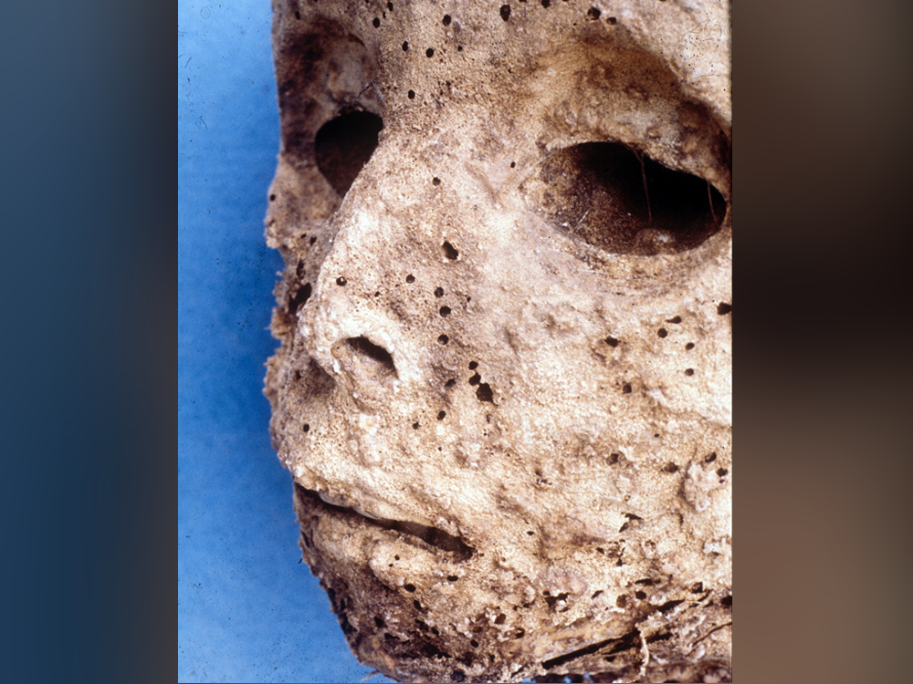 جثة من القرن السادس عشر تكشف تاريخ تطور التهاب الكبد الوبائي