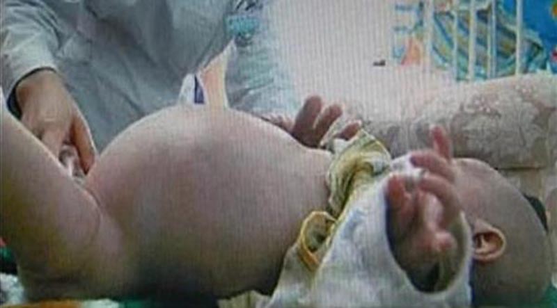 ولادة طفل حاملًا في شقيقه التوأم!