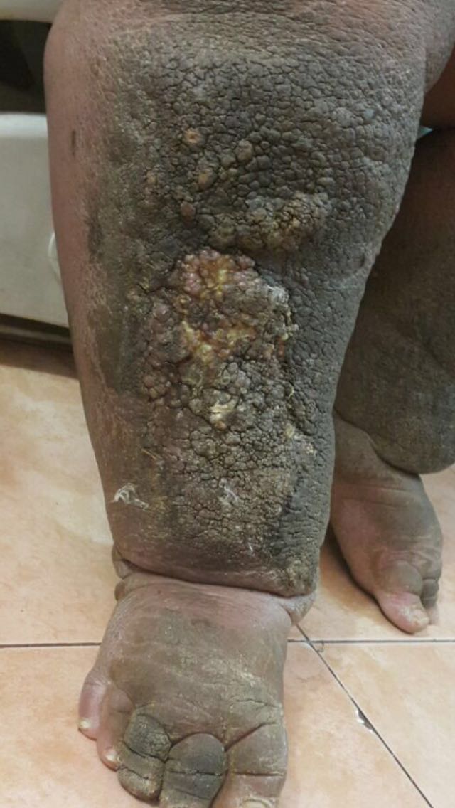 “فوزية” تعاني من داء الفيل بعد تشخيص خاطئ.. والصحة ترفض علاجها