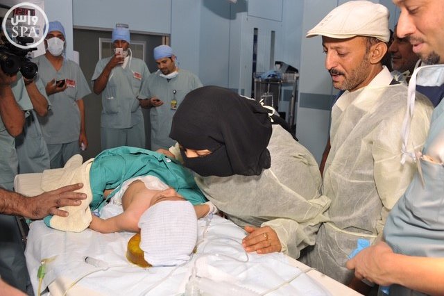 #المملكة أجرت عمليات فصل سيامي لأطفال من 19 دولة خلال 26 عامًا