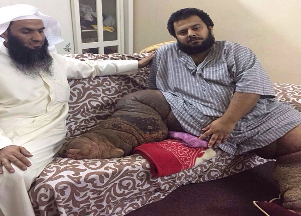 “الصحة”: نقل مواطن مصاب بمرض خطير في قدميه إلى مدينة الملك عبدالله الطبية