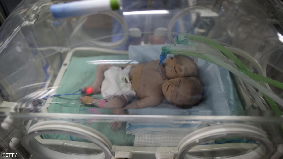 وفاة التوأم السيامي في غزة بعد أسبوع من ولادتهما