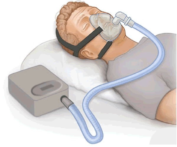 جهاز لمساعدة مرضى الانسداد الرئوي المزمن على التنفس