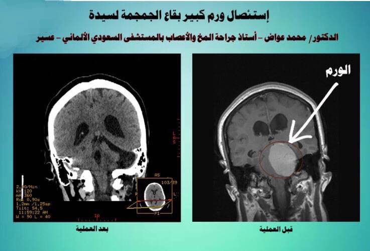 استئصال ورم كبير بقاع جمجمة سيدة بـ”ألماني عسير”