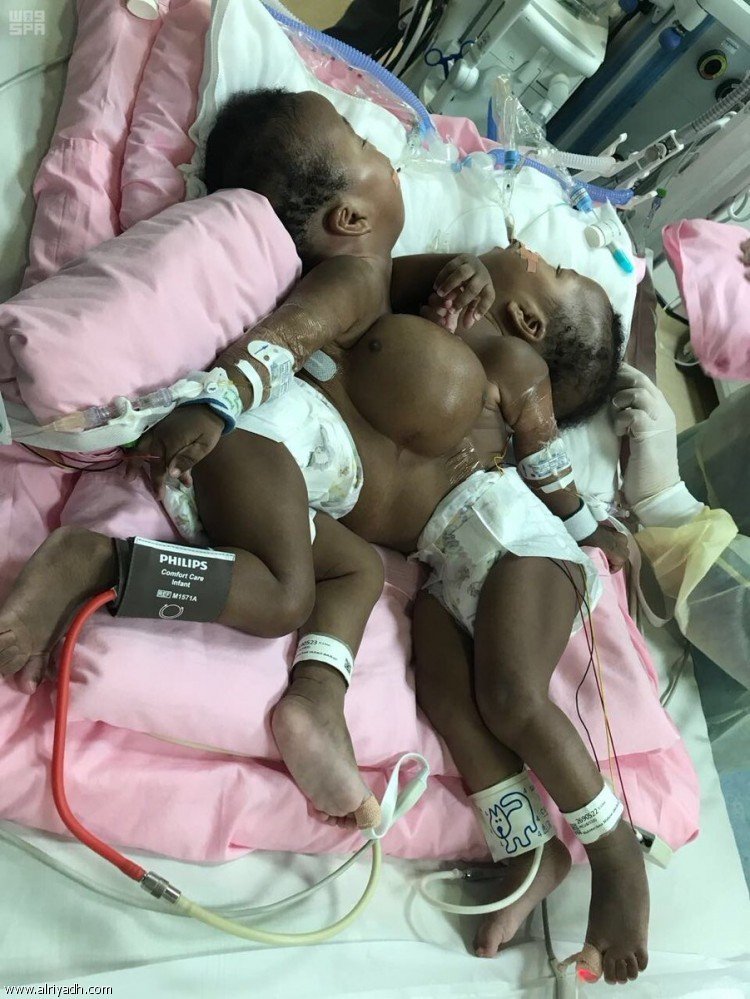 جراحة الـ9 ساعات تنجح في فصل التوأم السوداني جود وجنى