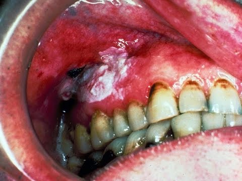 ثلث حالات سرطان الفم بالمملكة في جازان