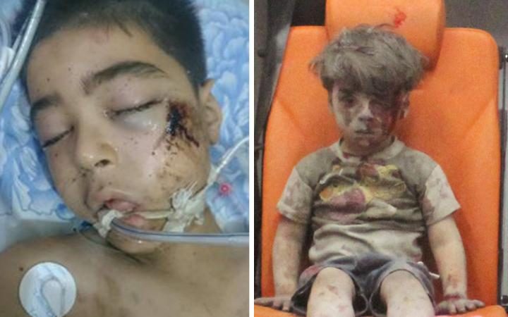 وفاة شقيق الطفل السوري “عمران دقنيش” متأثراً بجراحه في حلب