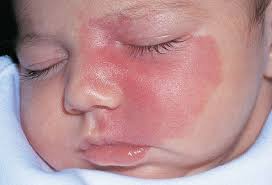 أسباب انتشار تصبغات الجلد لدى الأطفال حديثي الولادة