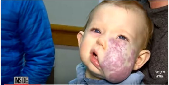 بالفيديو.. كيف تشوه هذا الطفل؟ وماذا فعل الجراحون في وجهه؟