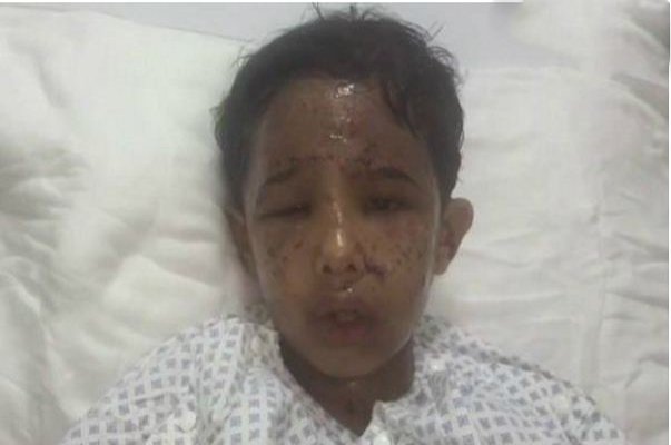 الطفل مهدي بعد إصابته بقذيفة حوثية : “احنا عيال ملكنا سلمان”