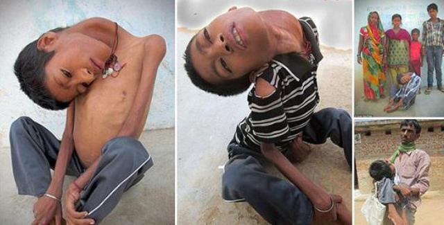 بالصور: طفل هندي يعيش برأس مقلوب للأسفل