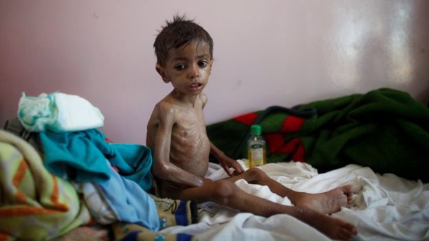 6 وفيات كل ساعة بين أطفال اليمن بسبب حصار الحوثي