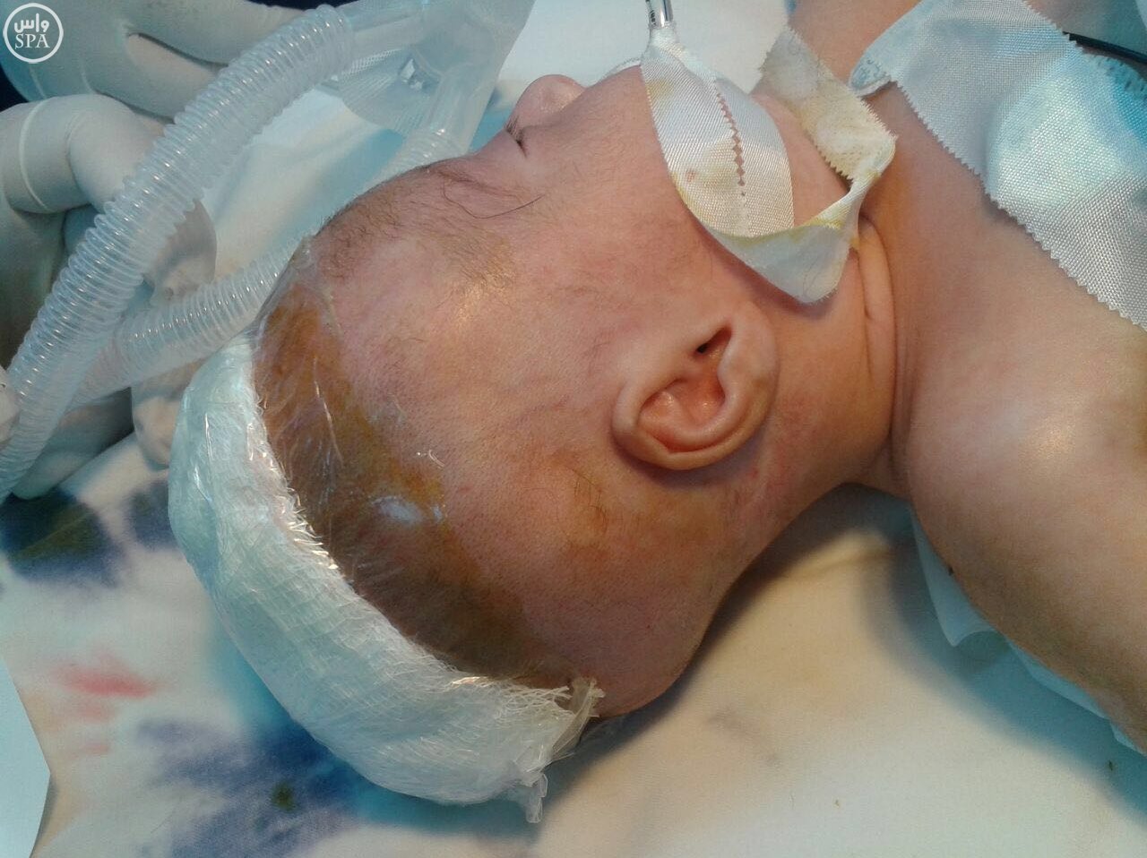 نجاح جراحي في #جازان.. إنقاذ مولودة مصابة بـ”الفتاق الدماغي”