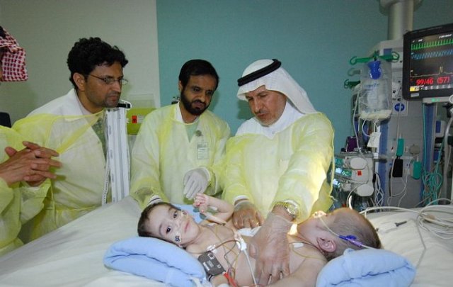 بدء عملية فصل التوأم السيامي اليمني عبدالعزيز وعبدالله