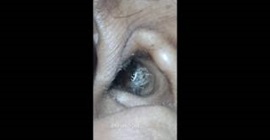 شاهد.. عنكبوت داخل أذن سيدة يُسبب لها صداعًا!