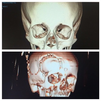 بالصور.. سعود الطبية تنهي معاناة فتاة أُصيبت عينها في حادث مروري