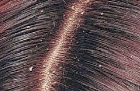 تعرّف على أسباب قشرة الشعر وطرق علاجها