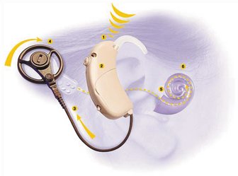 اعتماد اشتراطات لعمليات قوقعة الأذن في المستشفيات الخاصة