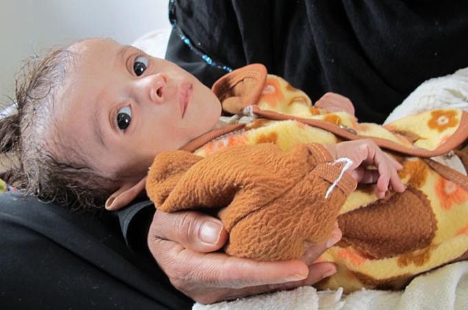 المجاعة تهدد اليمن ومنظّمات أممية تكشف بالأرقام نتائج الانقلاب