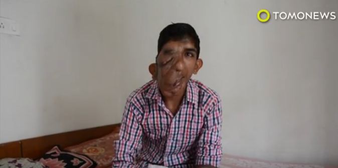 بالفيديو.. كيف حول الورم الليفي وجه مراهق هندي الى وحش