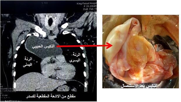 نجاح جراحة نادرة لاستئصال أكبر “تكيس” في العالم من صدر أربعينية بـ #الطائف