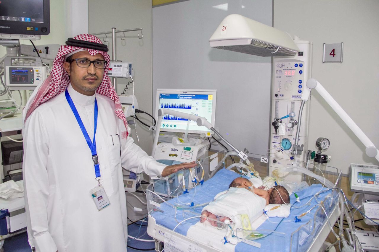 ولادة توأم سيامي يمني الجنسية بمستشفى أبها للولادة والأطفال (2)
