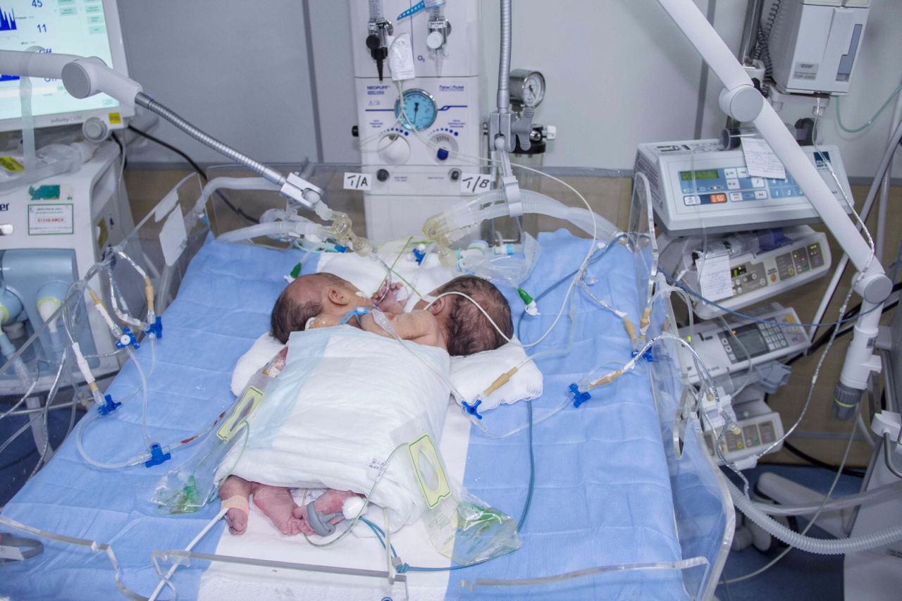 ولادة توأمين سياميين يمنيين ملتصقين من الصدر والبطن بمستشفى أبها