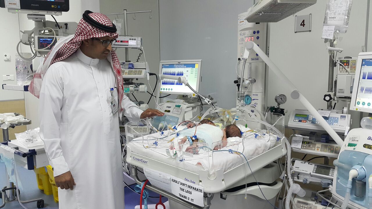 ولادة توأم سيامي يمني الجنسية بمستشفى أبها للولادة والأطفال (5)