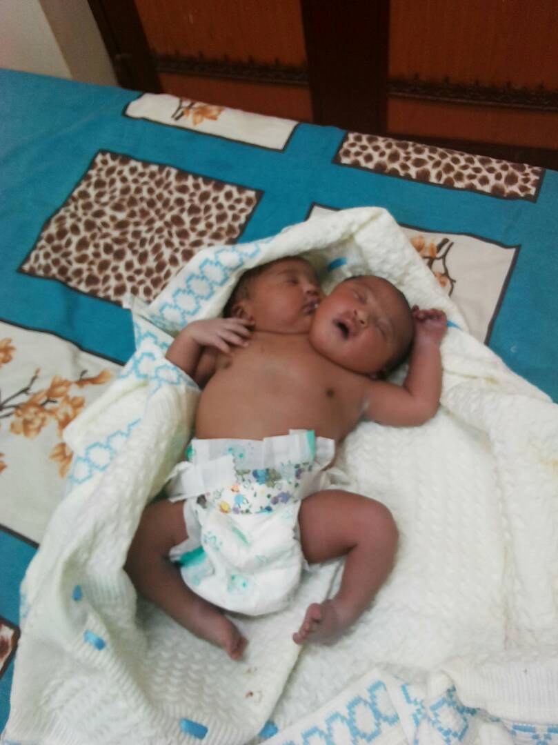 ولادة طفل برأسين في النيل الأبيض
