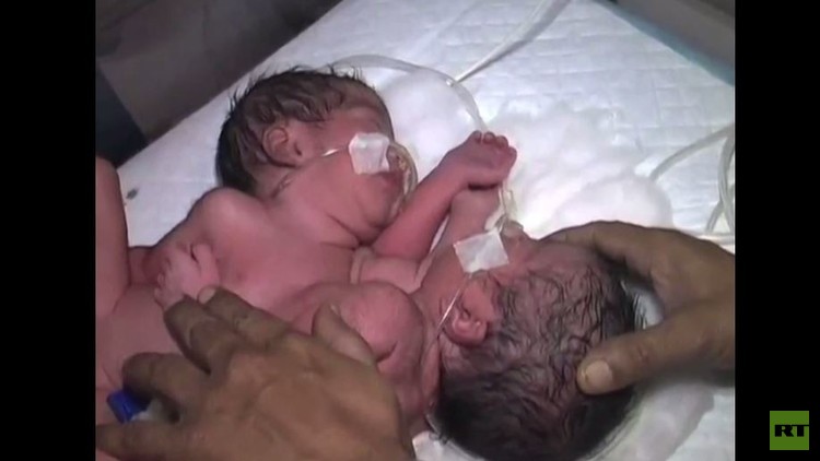 بالفيديو.. ولادة نادرة لتوأمين ملتصقين بالهند